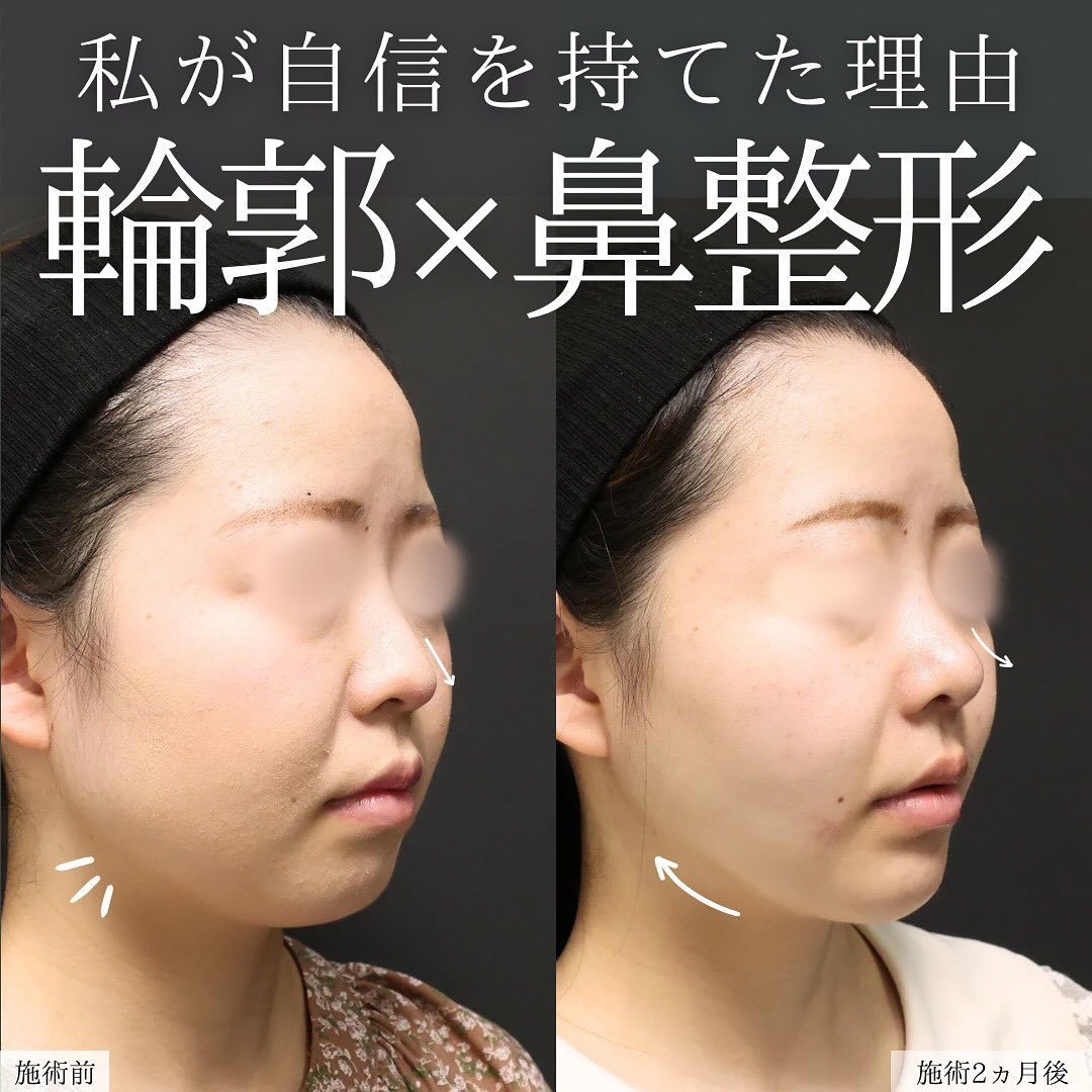 鼻尖形成・鼻尖縮小/鼻先軟骨移植/TAC式 ツヤ肌コラーゲンリフト®の症例写真 施術前後