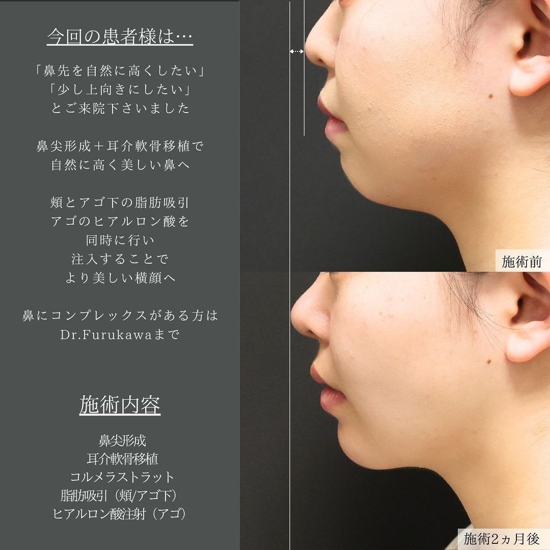 鼻尖形成・鼻尖縮小/鼻先軟骨移植/TAC式 ツヤ肌コラーゲンリフト®の症例写真 施術前後