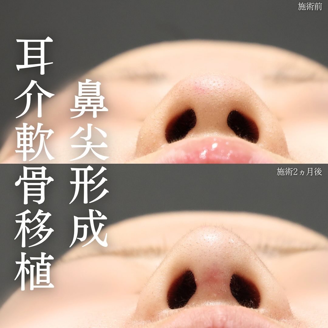 鼻尖形成・鼻尖縮小/鼻先軟骨移植/TAC式 ツヤ肌コラーゲンリフト®の症例写真 施術前後 