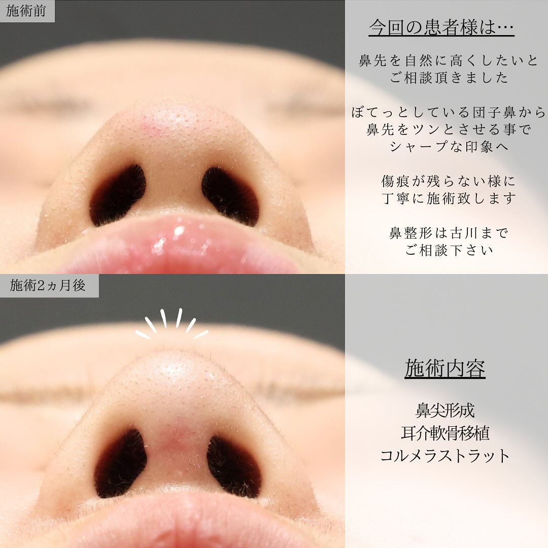 鼻尖形成・鼻尖縮小/鼻先軟骨移植/TAC式 ツヤ肌コラーゲンリフト®の症例写真 施術前後 