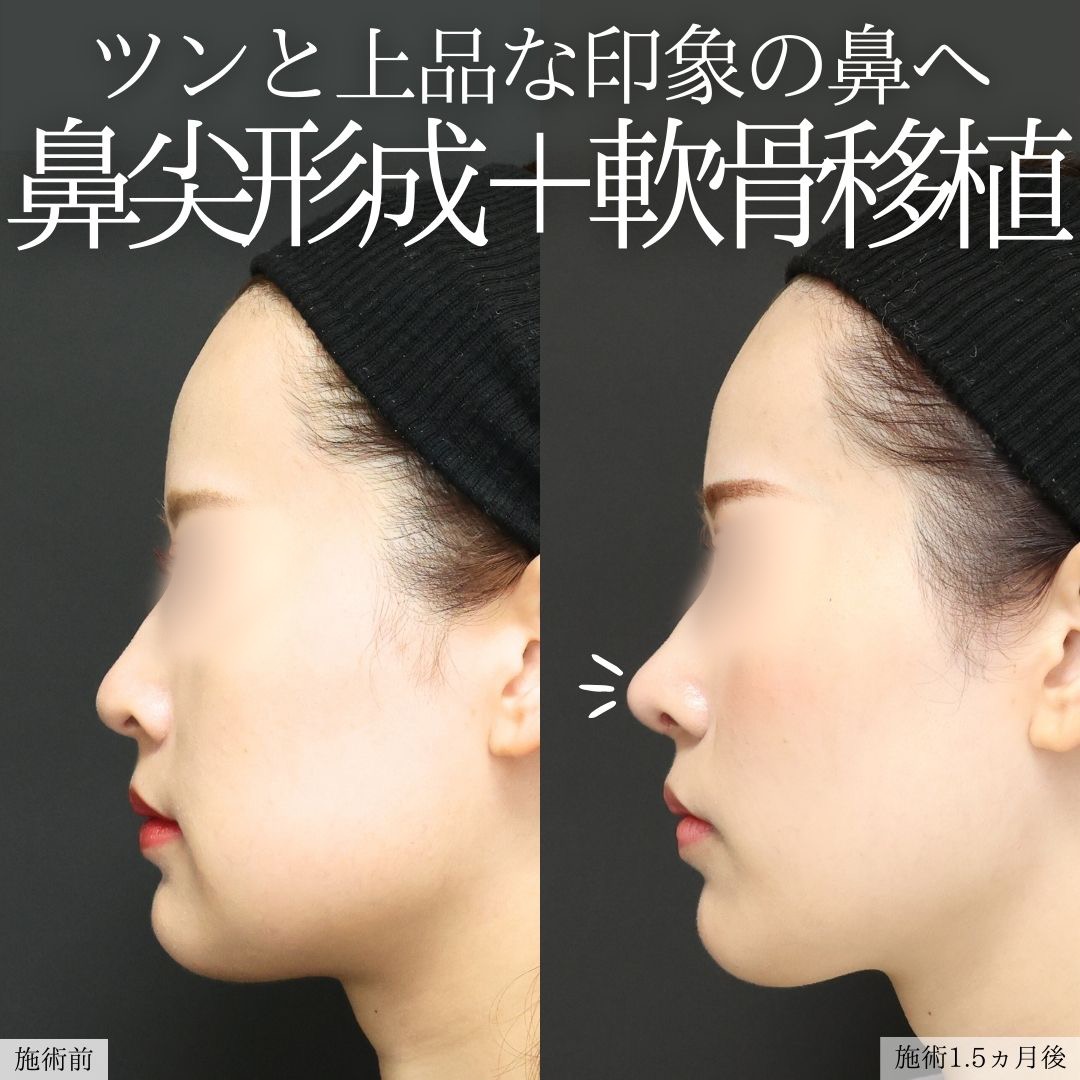 鼻尖形成・鼻尖縮小/鼻先軟骨移植の症例写真 施術前後 