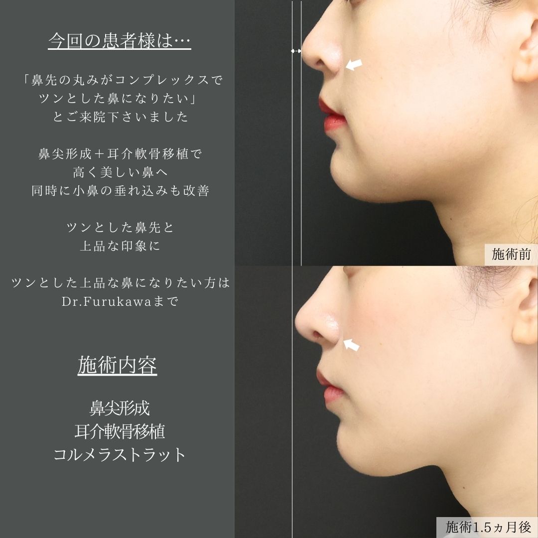 鼻尖形成・鼻尖縮小/鼻先軟骨移植の症例写真 施術前後 