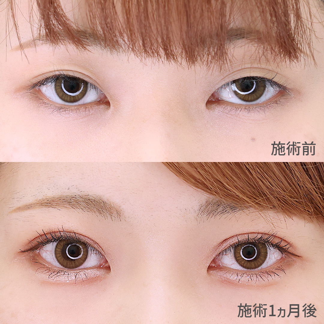 【二重埋没法】自然な平行二重で華やかな目元に変化
