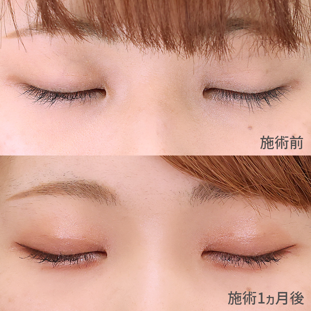 二重埋没法の症例写真 施術前後 