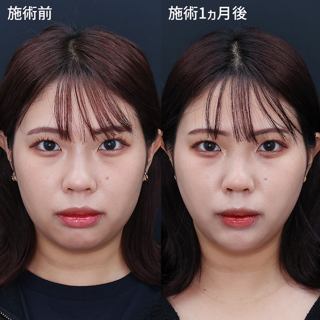 【糸リフト（ツヤ肌コラーゲンリフト®極）】でお顔のたるみを解消して美しいフェイスラインへ