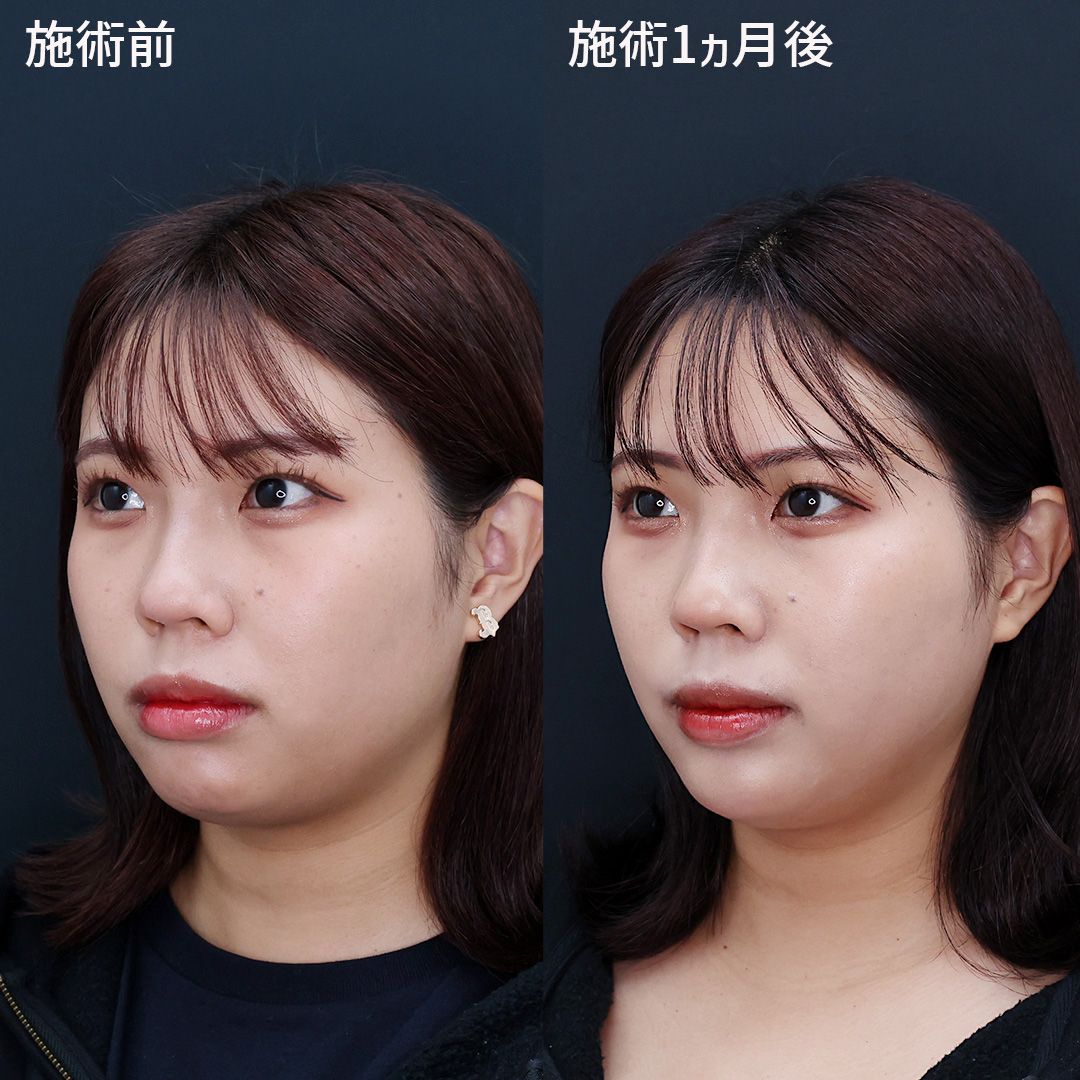 TAC式 ツヤ肌コラーゲンリフト®/顎のヒアルロン酸注射/エラボトックス注射の症例写真 施術前後 