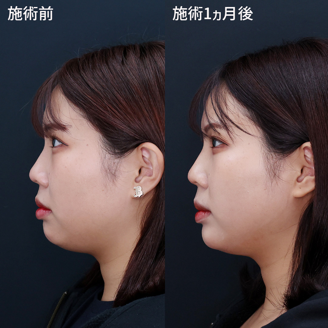TAC式 ツヤ肌コラーゲンリフト®/顎のヒアルロン酸注射/エラボトックス注射の症例写真 施術前後 