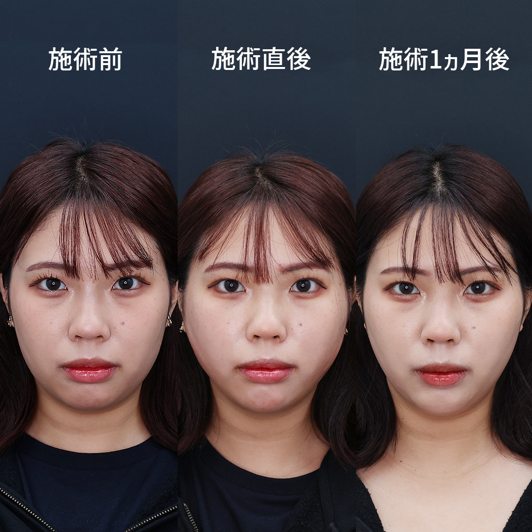 TAC式 ツヤ肌コラーゲンリフト®/顎のヒアルロン酸注射/エラボトックス注射の症例写真 施術前後 