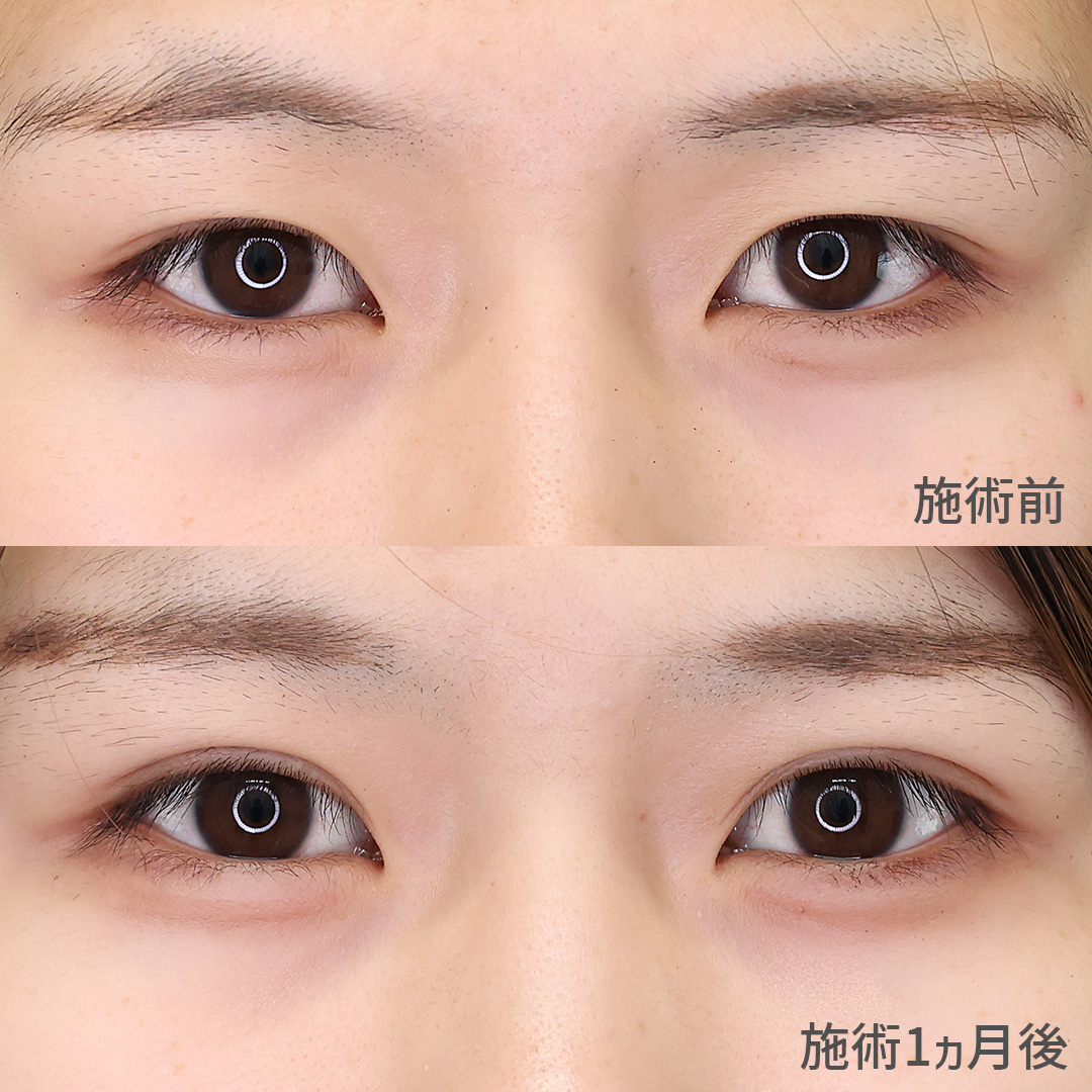 目元の印象がしっかり変わる！ミックス型へアップグレード！！