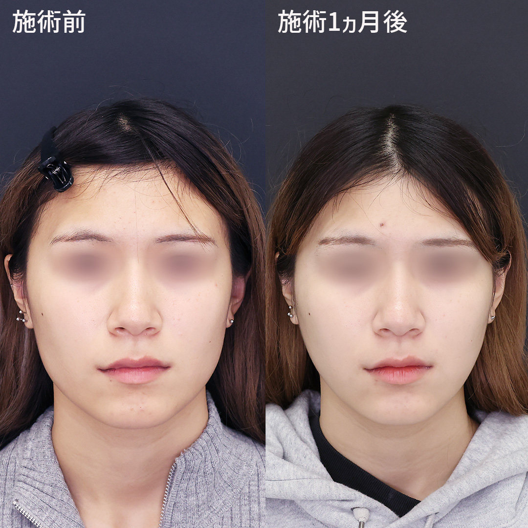 TAC式 ツヤ肌コラーゲンリフト®/エラボトックス注射/ボトックス注射：その他の症例写真 施術前後 