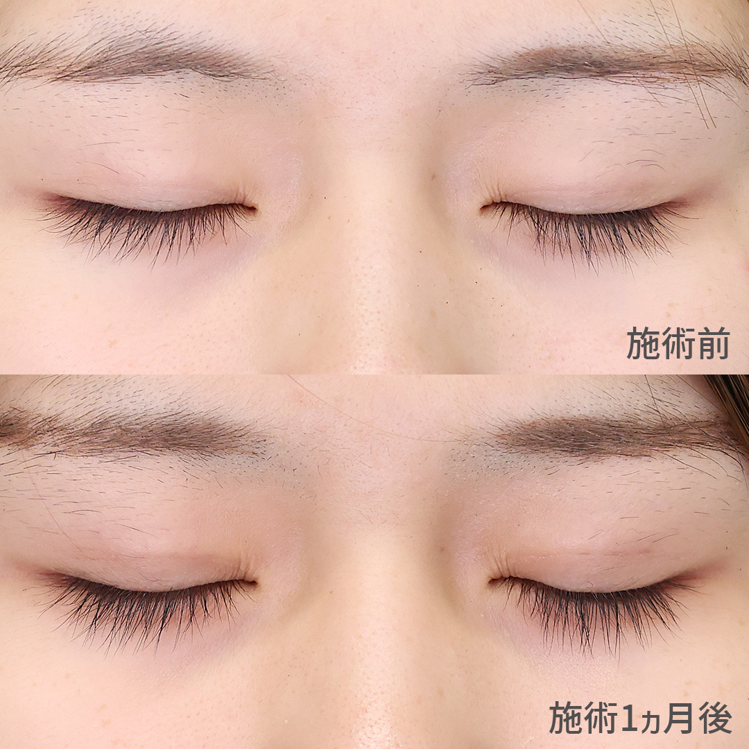 二重埋没法の症例写真 施術前後 