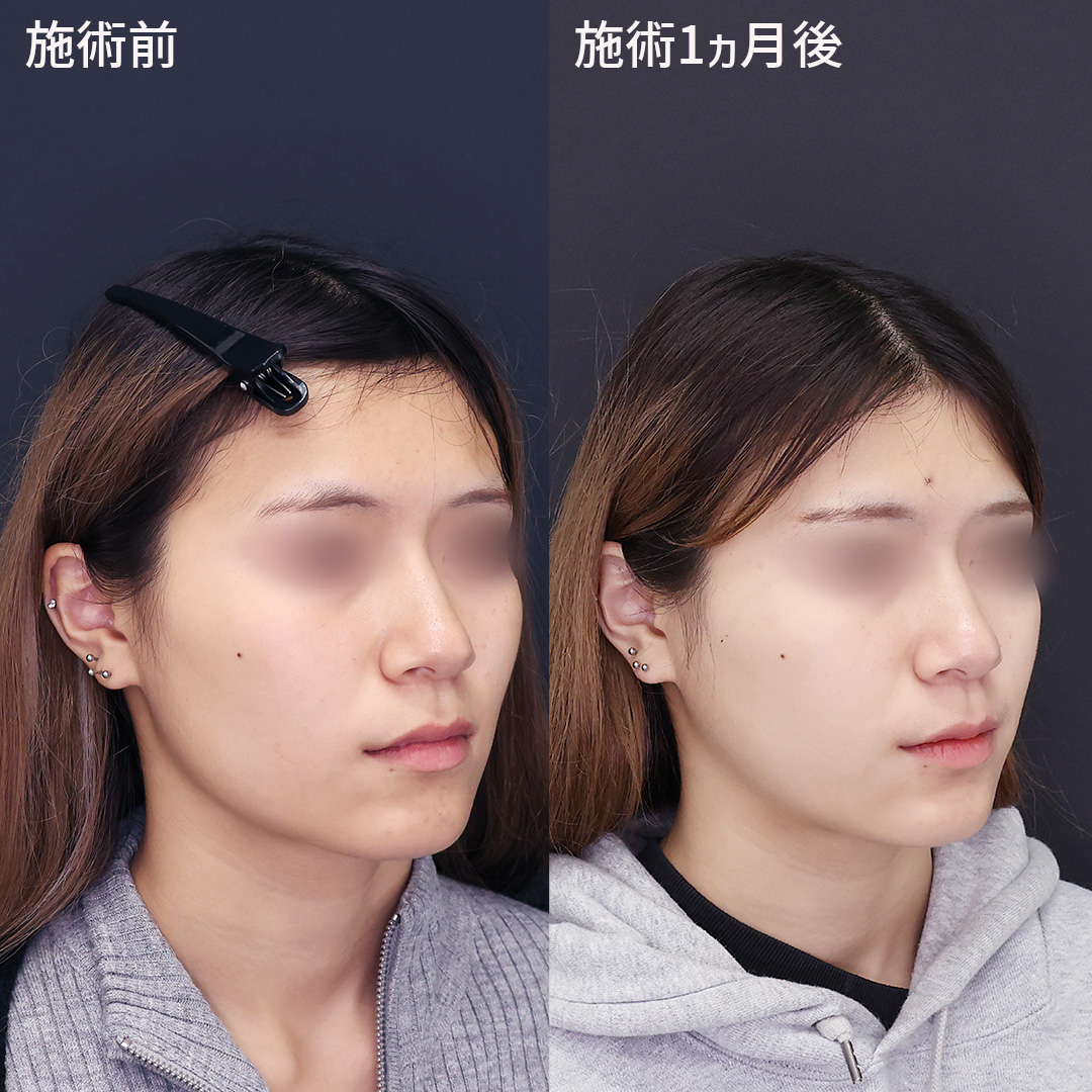 TAC式 ツヤ肌コラーゲンリフト®/エラボトックス注射/ボトックス注射：その他の症例写真 施術前後 