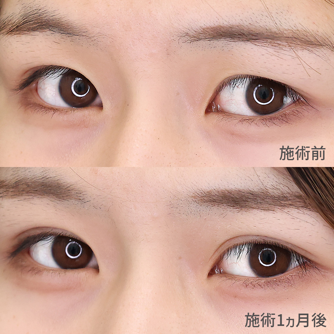 二重埋没法の症例写真 施術前後 