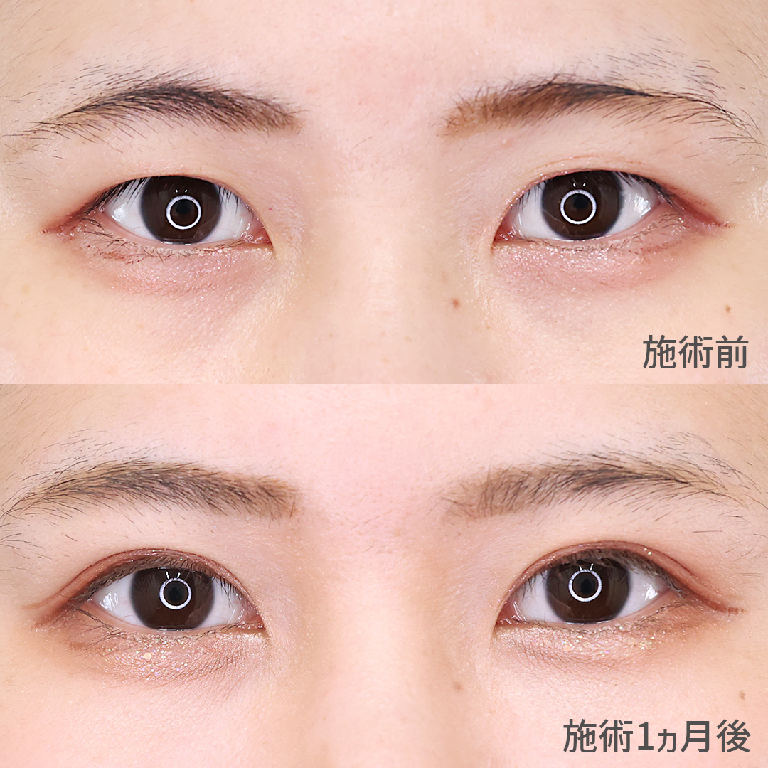 年月の経った埋没法の留め直し。生まれ変わった目元は華やかな末広型二重！