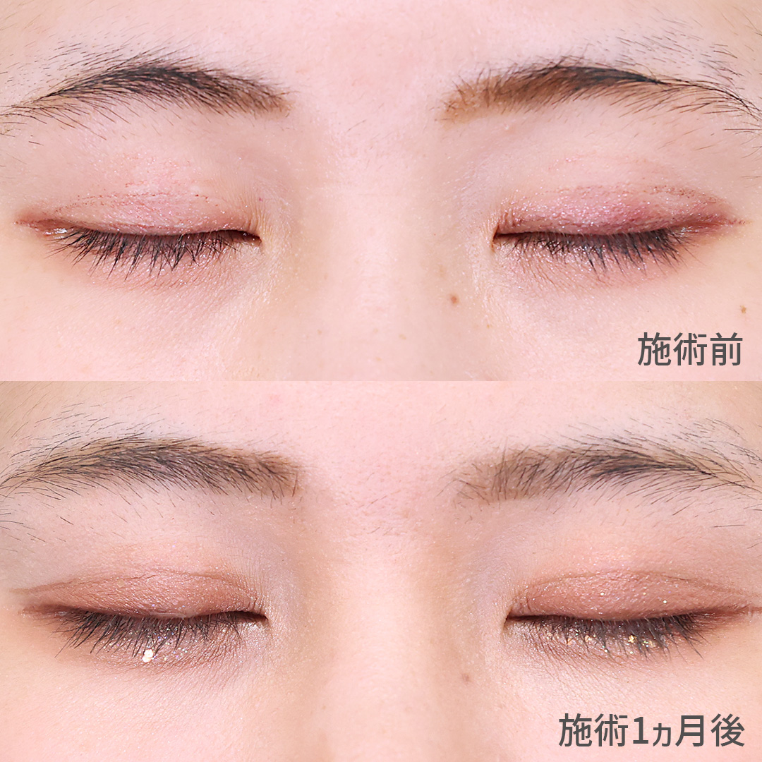 二重埋没法の症例写真 施術前後 