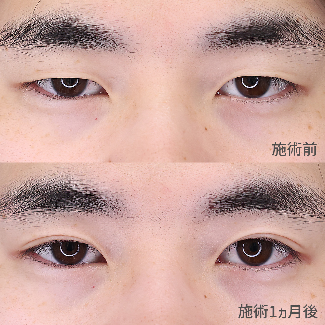 男性二重整形で目の開きがパッチリ改善！！