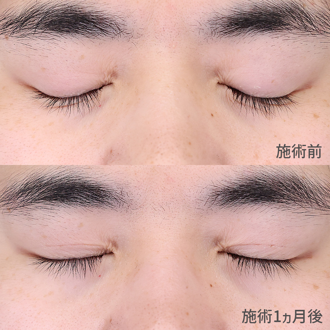 二重埋没法の症例写真 施術前後 