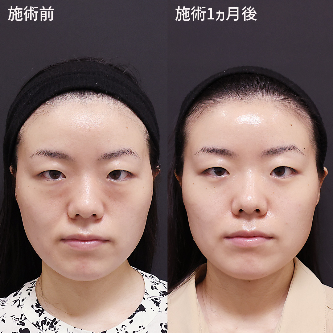 疲れた印象を与えていた目の下のクマを撃退！