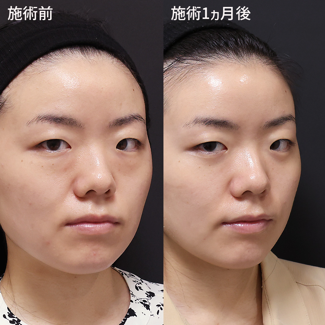 下眼瞼脱脂術（目の下のたるみ取り・目の下の脂肪ふくらみ取り）の症例写真 施術前後 