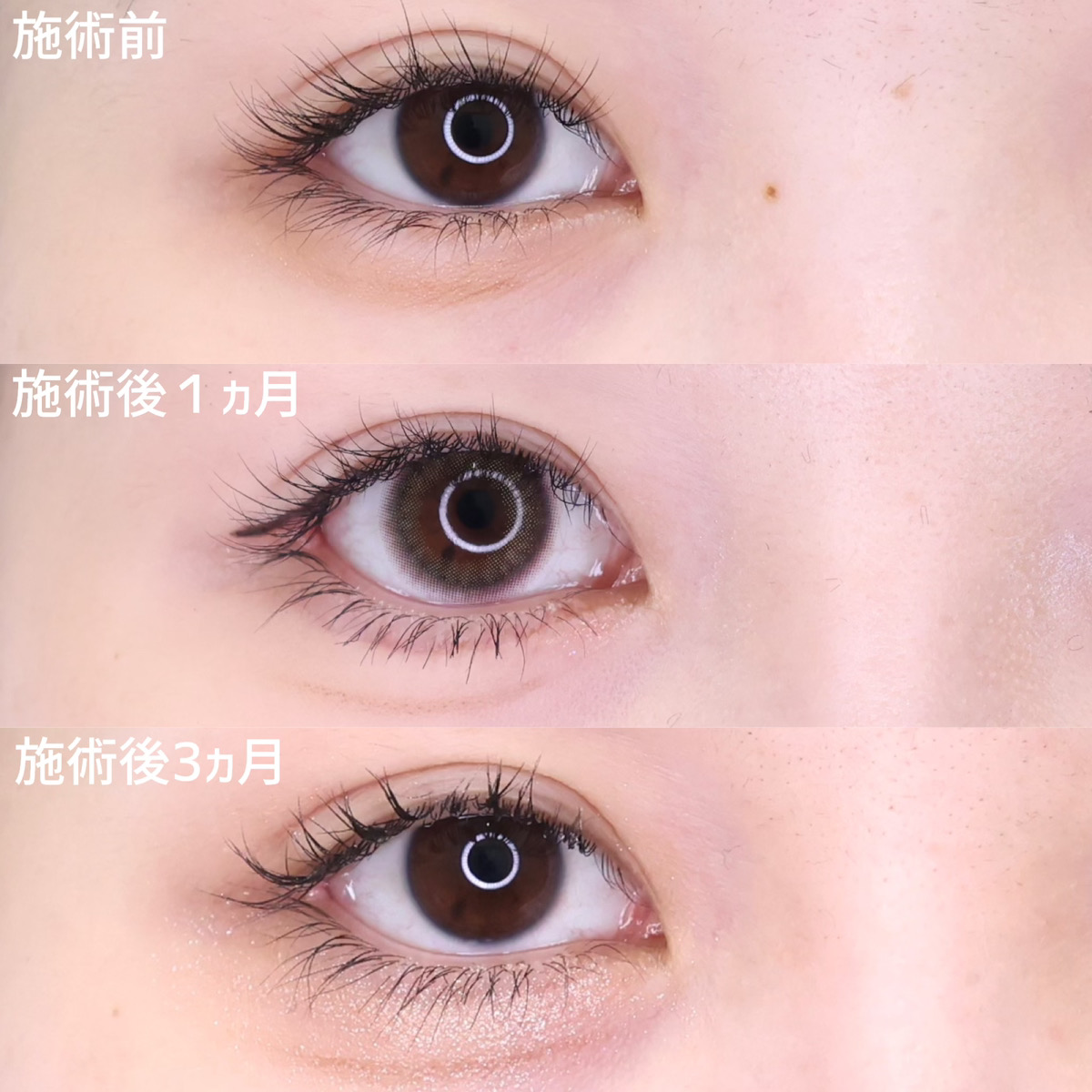 目尻切開術/グラマラスライン（タレ目形成）の症例写真 施術前後 