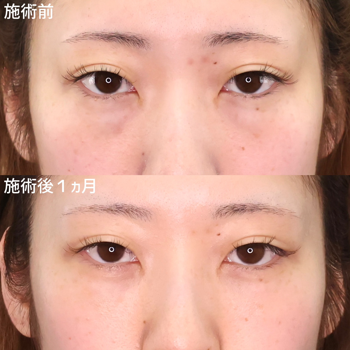 顔の脂肪注入(コンデンスリッチフェイス)/下眼瞼脱脂術(目の下のたるみ取り・目の下の脂肪ふくらみ取り)の症例写真 施術前後