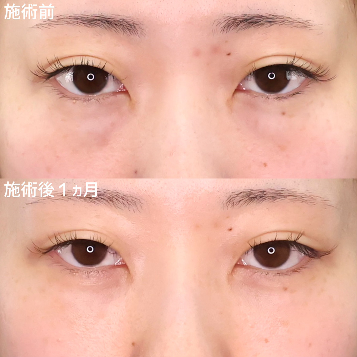 顔の脂肪注入(コンデンスリッチフェイス)/下眼瞼脱脂術(目の下のたるみ取り・目の下の脂肪ふくらみ取り)の症例写真 施術前後