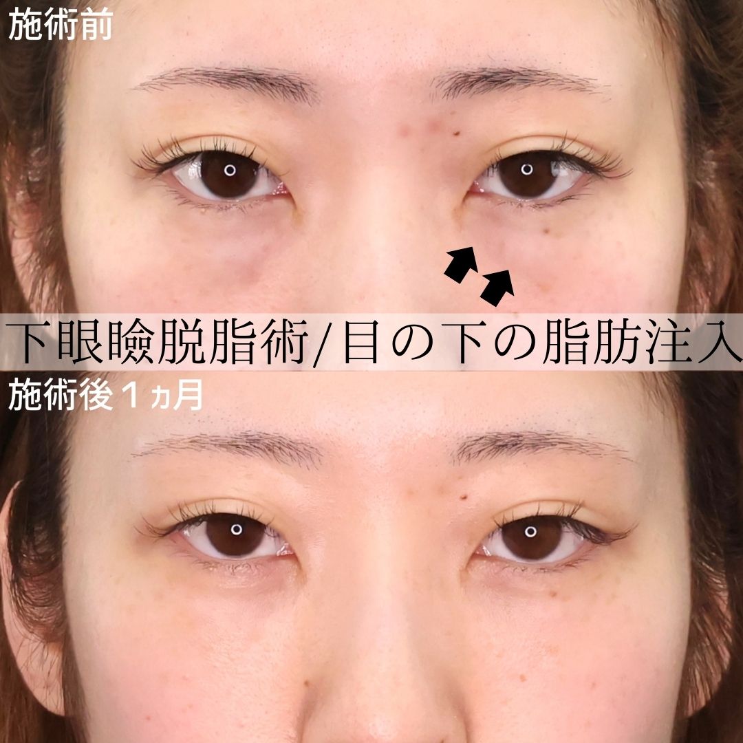顔の脂肪注入(コンデンスリッチフェイス)/下眼瞼脱脂術(目の下のたるみ取り・目の下の脂肪ふくらみ取り)の症例写真 施術前後