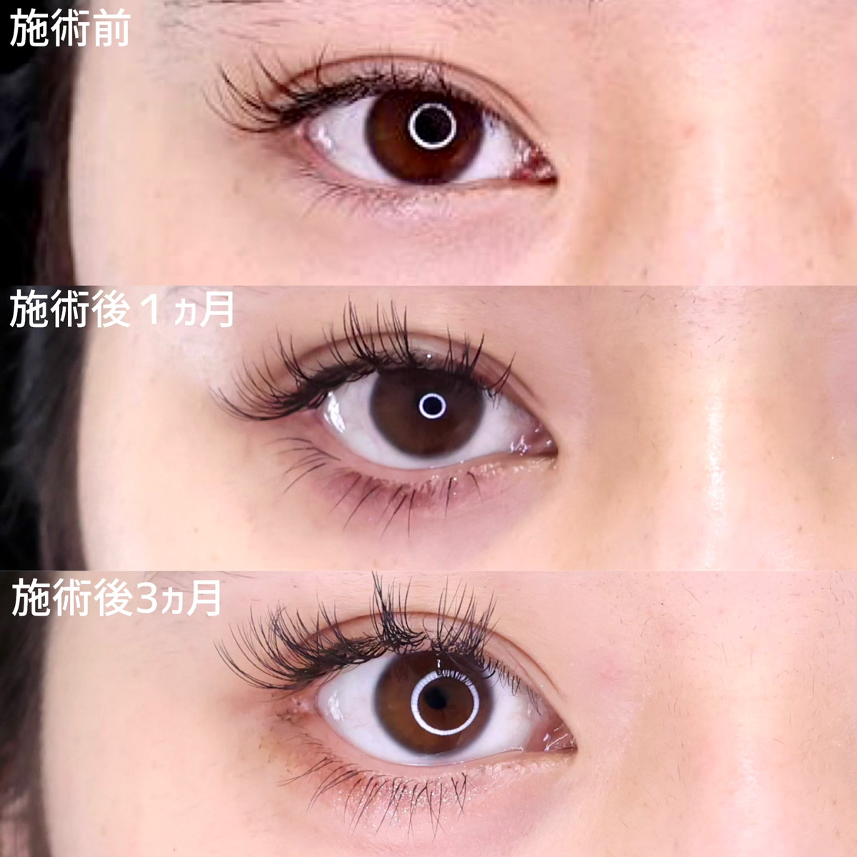 目尻切開術/グラマラスライン（タレ目形成）/下眼瞼脱脂術（目の下のたるみ取り・目の下の脂肪ふくらみ取り）の症例写真 施術前後 