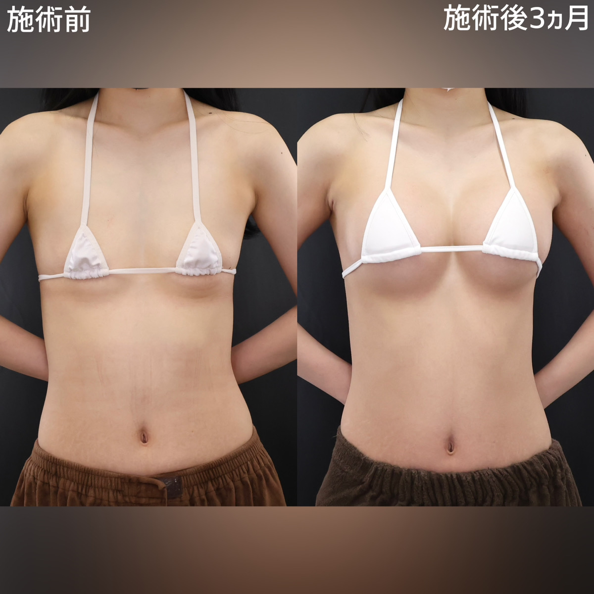 シリコンバッグ豊胸（人工乳腺バッグ）/脂肪注入豊胸（コンデンスリッチ・ピュアグラフト・１day脂肪豊胸）の症例写真 施術前後 