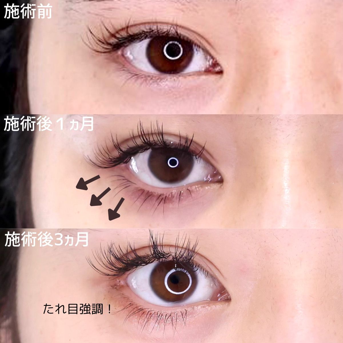 目尻切開術/グラマラスライン（タレ目形成）/下眼瞼脱脂術（目の下のたるみ取り・目の下の脂肪ふくらみ取り）の症例写真 施術前後 