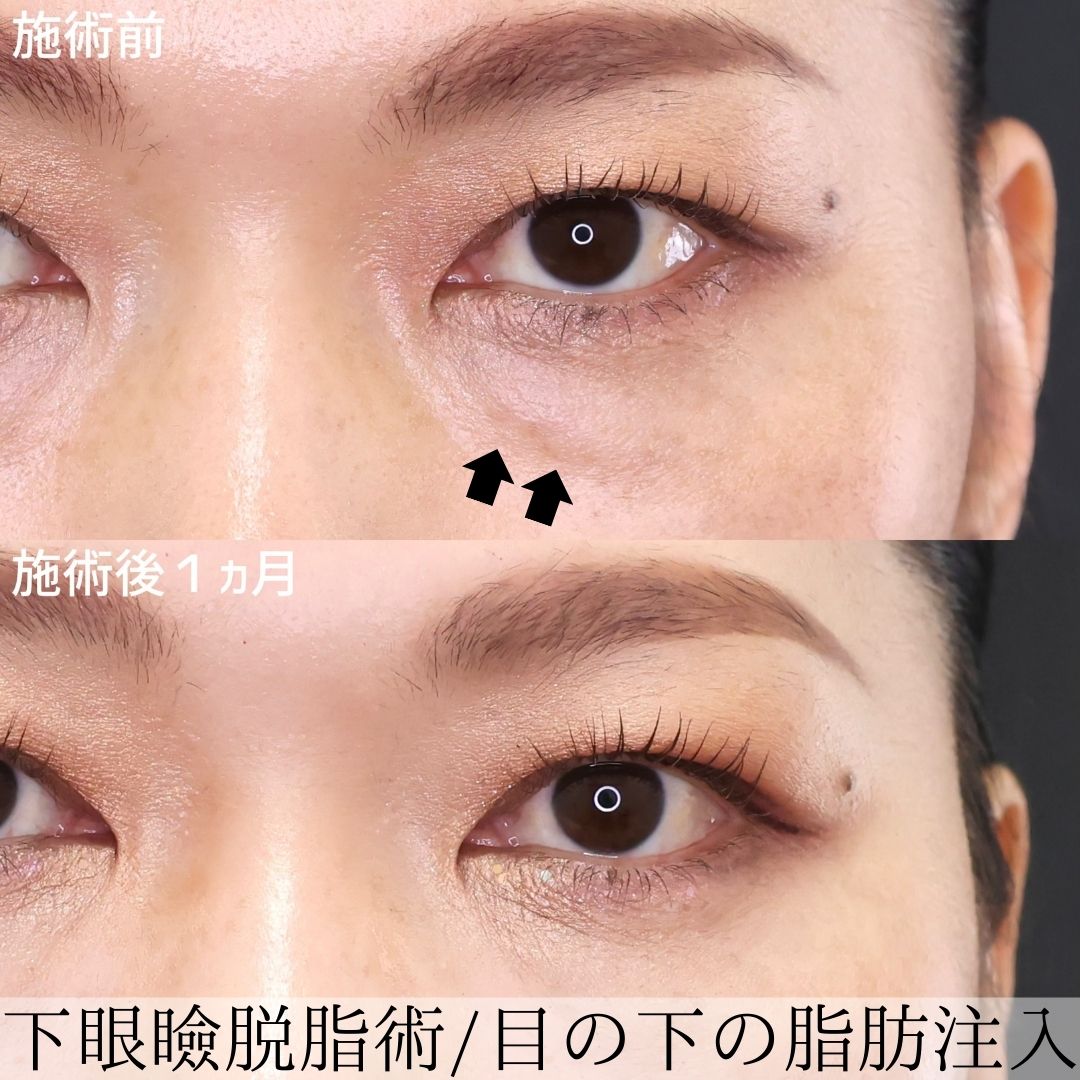 下眼瞼脱脂術（目の下のたるみ取り・目の下の脂肪ふくらみ取り）/顔の脂肪注入(コンデンスリッチフェイス)の症例写真 施術前後 