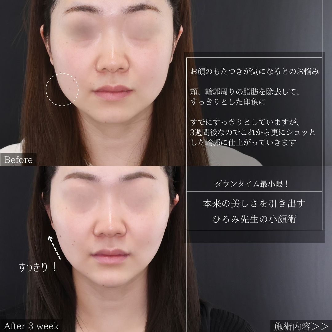 TAC式 ツヤ肌コラーゲンリフト®/顔の脂肪吸引/Lラインファット除去（エラ下脂肪除去）の症例写真 施術前後 