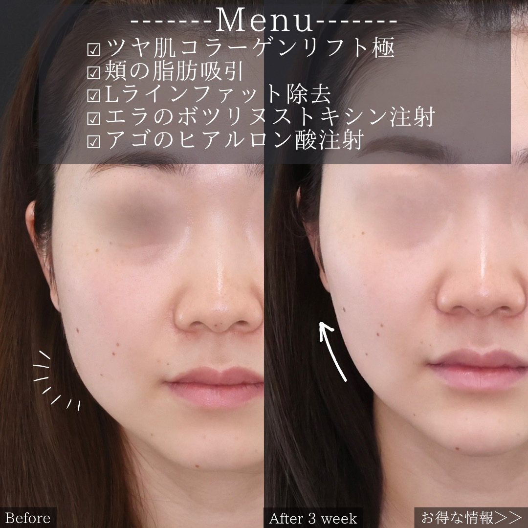 TAC式 ツヤ肌コラーゲンリフト®/顔の脂肪吸引/Lラインファット除去（エラ下脂肪除去）の症例写真 施術前後 
