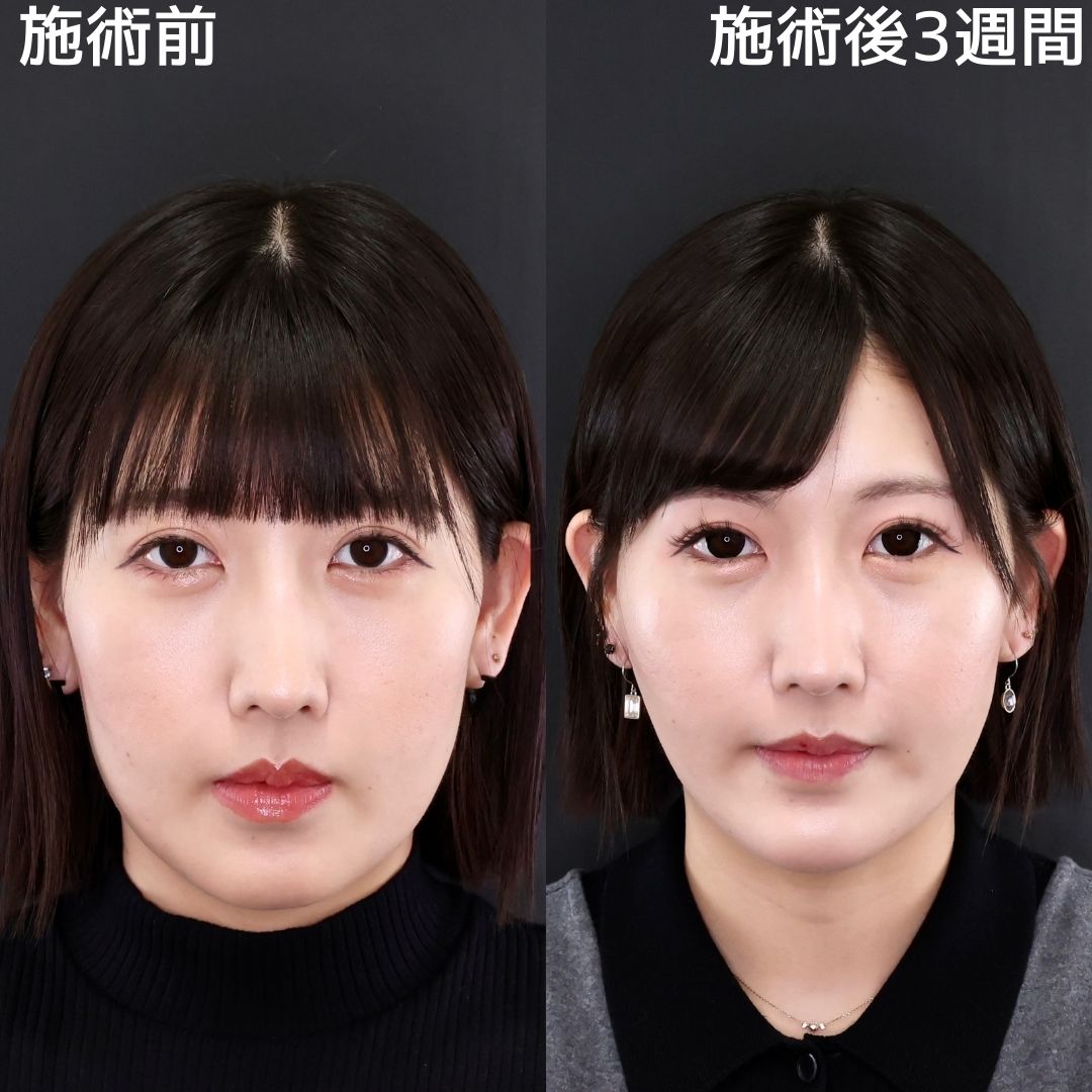 TAC式 ツヤ肌コラーゲンリフト®/ジョールファット除去/Lラインファット除去(エラ下脂肪除去)の症例写真 施術前後