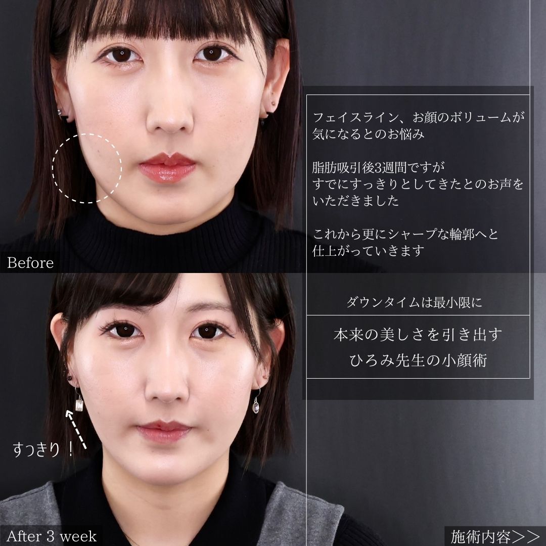 TAC式 ツヤ肌コラーゲンリフト®/ジョールファット除去/Lラインファット除去(エラ下脂肪除去)の症例写真 施術前後