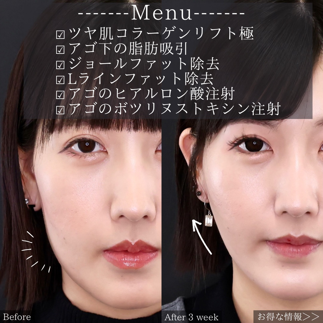 TAC式 ツヤ肌コラーゲンリフト®/ジョールファット除去/Lラインファット除去(エラ下脂肪除去)の症例写真 施術前後