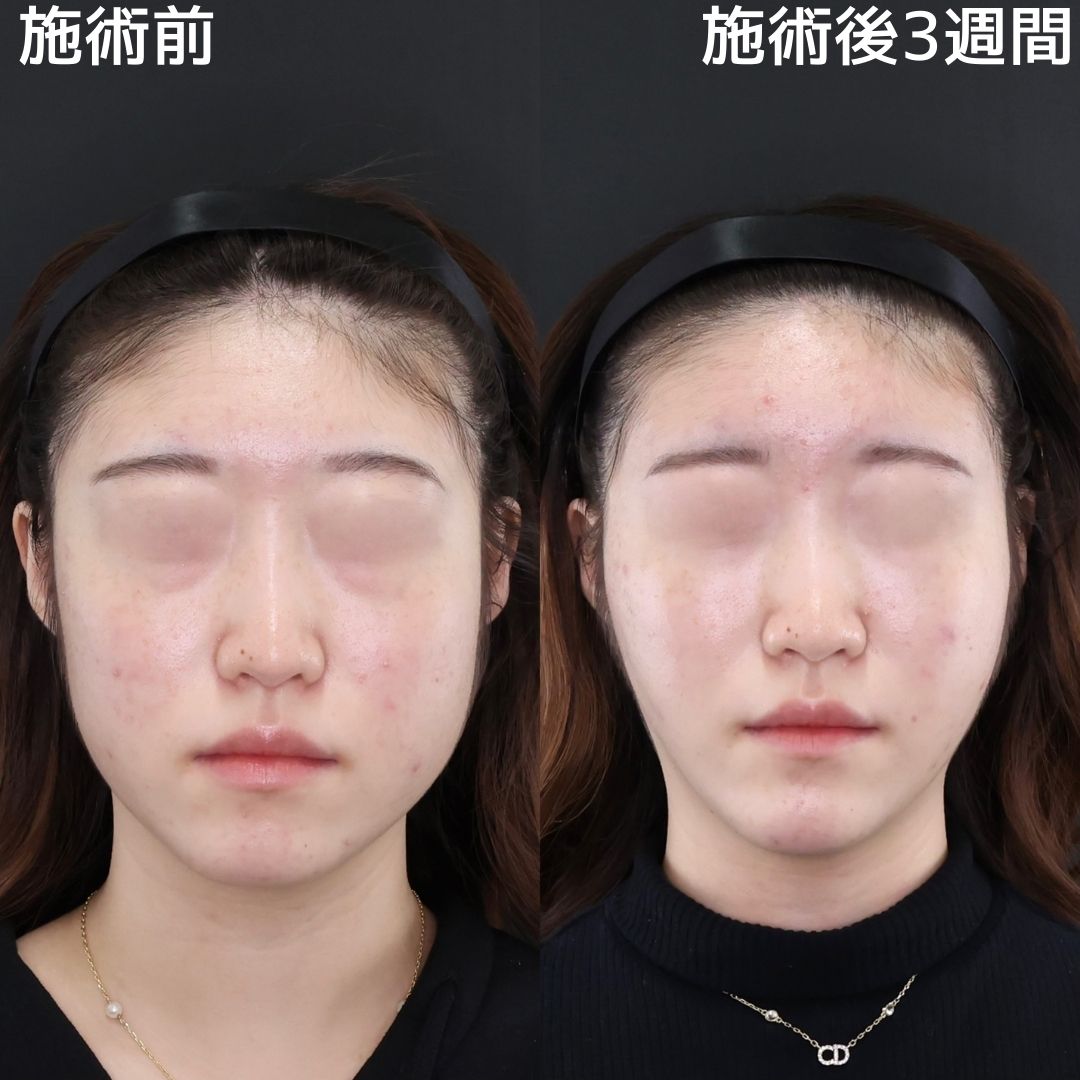 【糸リフト×脂肪除去×クマ取り×額の脂肪注入】お顔のトータルプロデュースで垢抜けフェイス