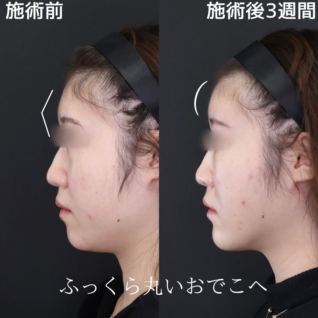 TAC式 ツヤ肌コラーゲンリフト®/Lラインファット除去（エラ下脂肪除去）/顔の脂肪吸引の症例写真 施術前後 