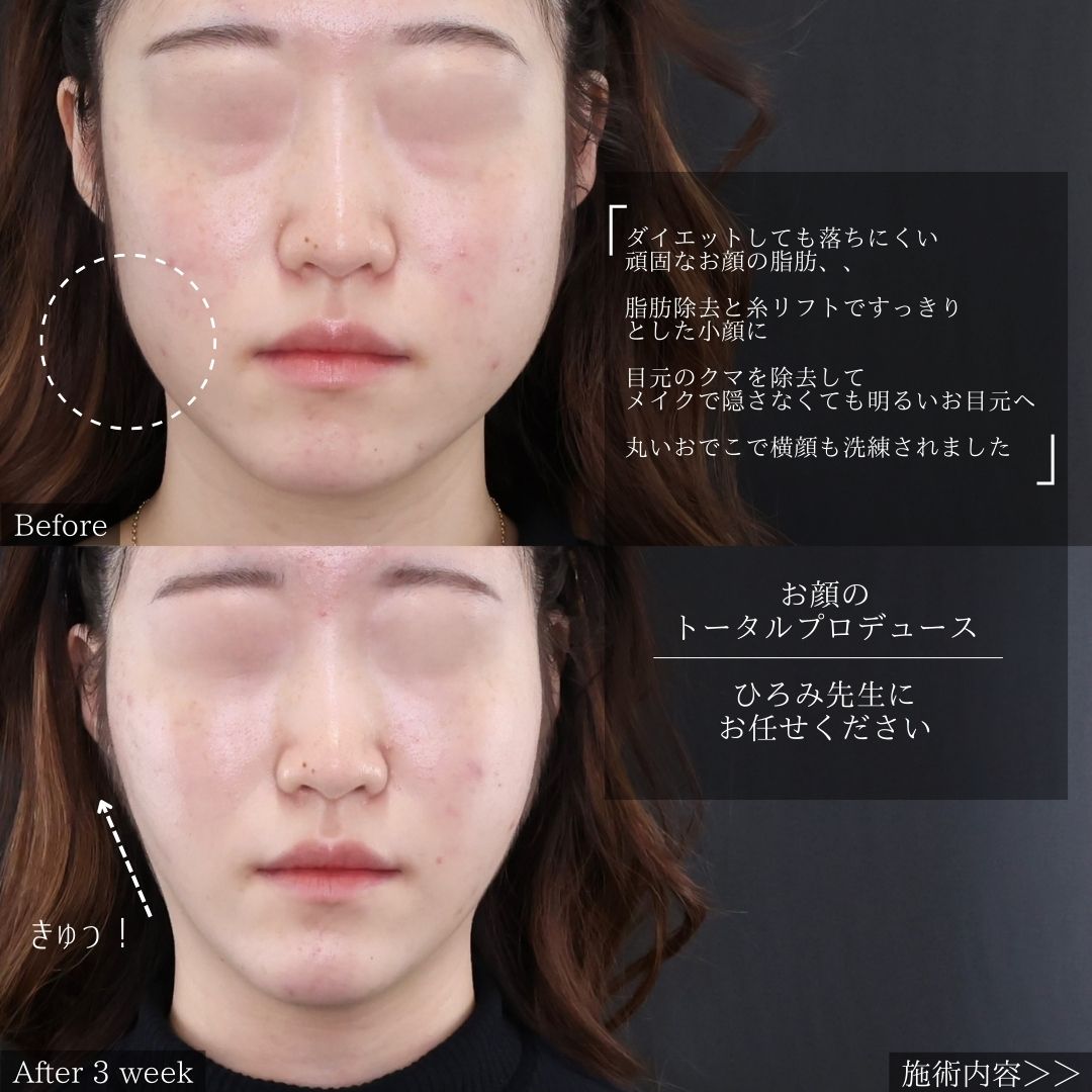 TAC式 ツヤ肌コラーゲンリフト®/Lラインファット除去（エラ下脂肪除去）/顔の脂肪吸引の症例写真 施術前後 