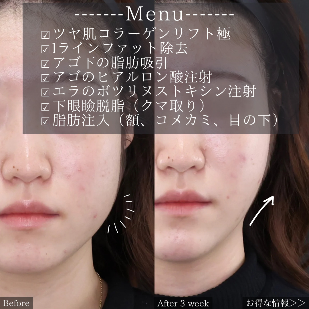 TAC式 ツヤ肌コラーゲンリフト®/Lラインファット除去（エラ下脂肪除去）/顔の脂肪吸引の症例写真 施術前後 