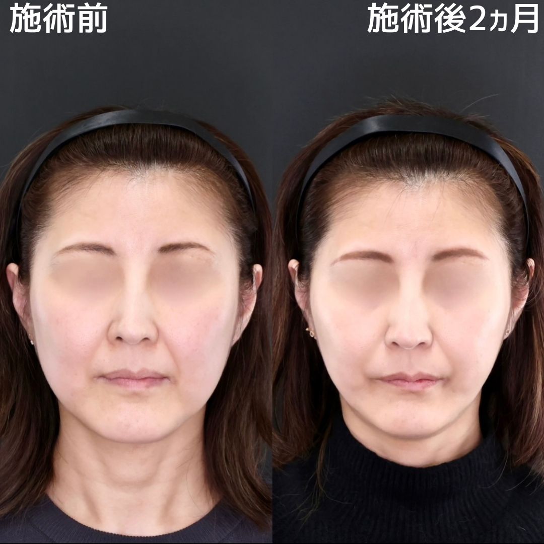 【糸リフト×脂肪除去】40代、若々しい小顔でもたつき0