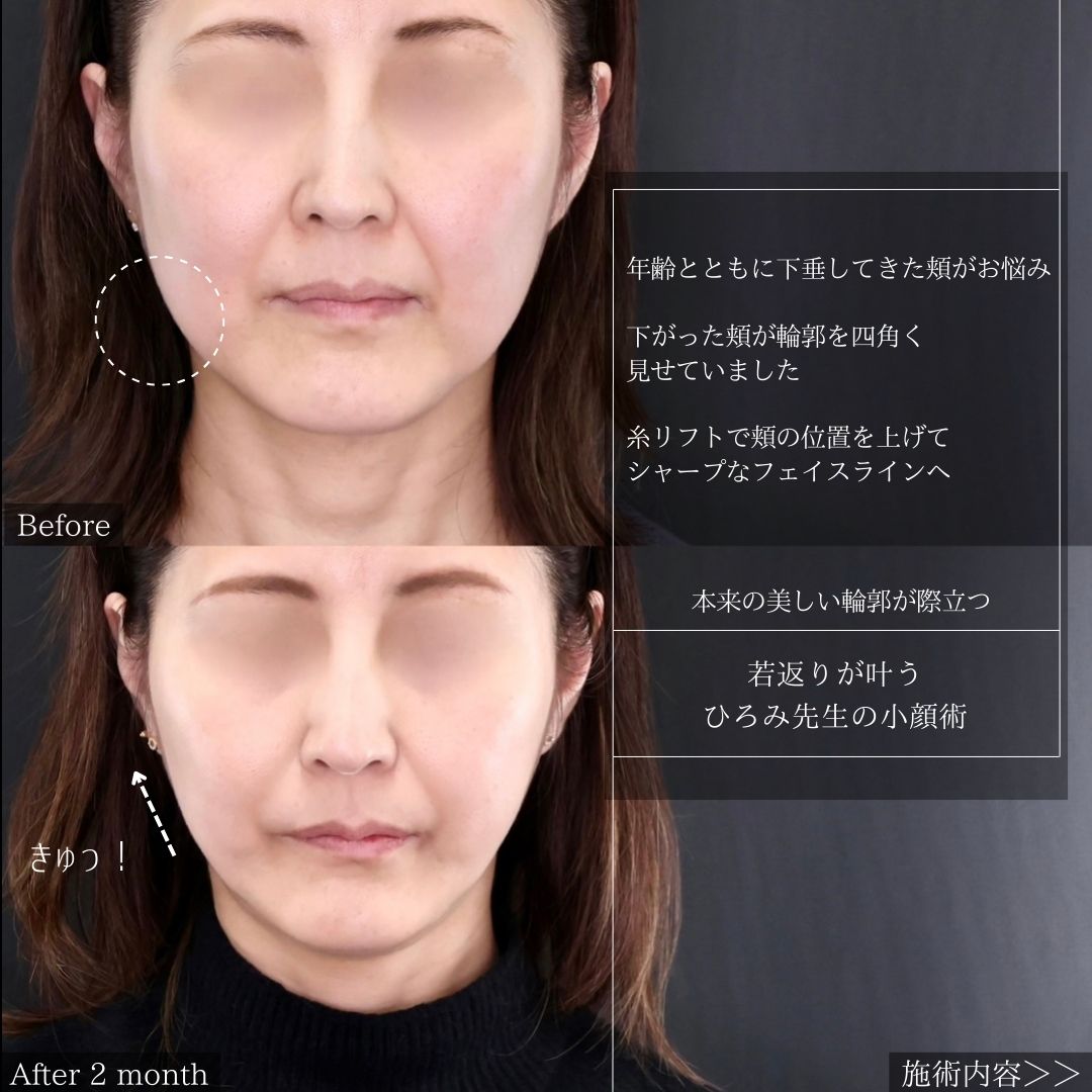 TAC式 ツヤ肌コラーゲンリフト®/ボトックス注射：その他/エラボトックス注射の症例写真 施術前後 