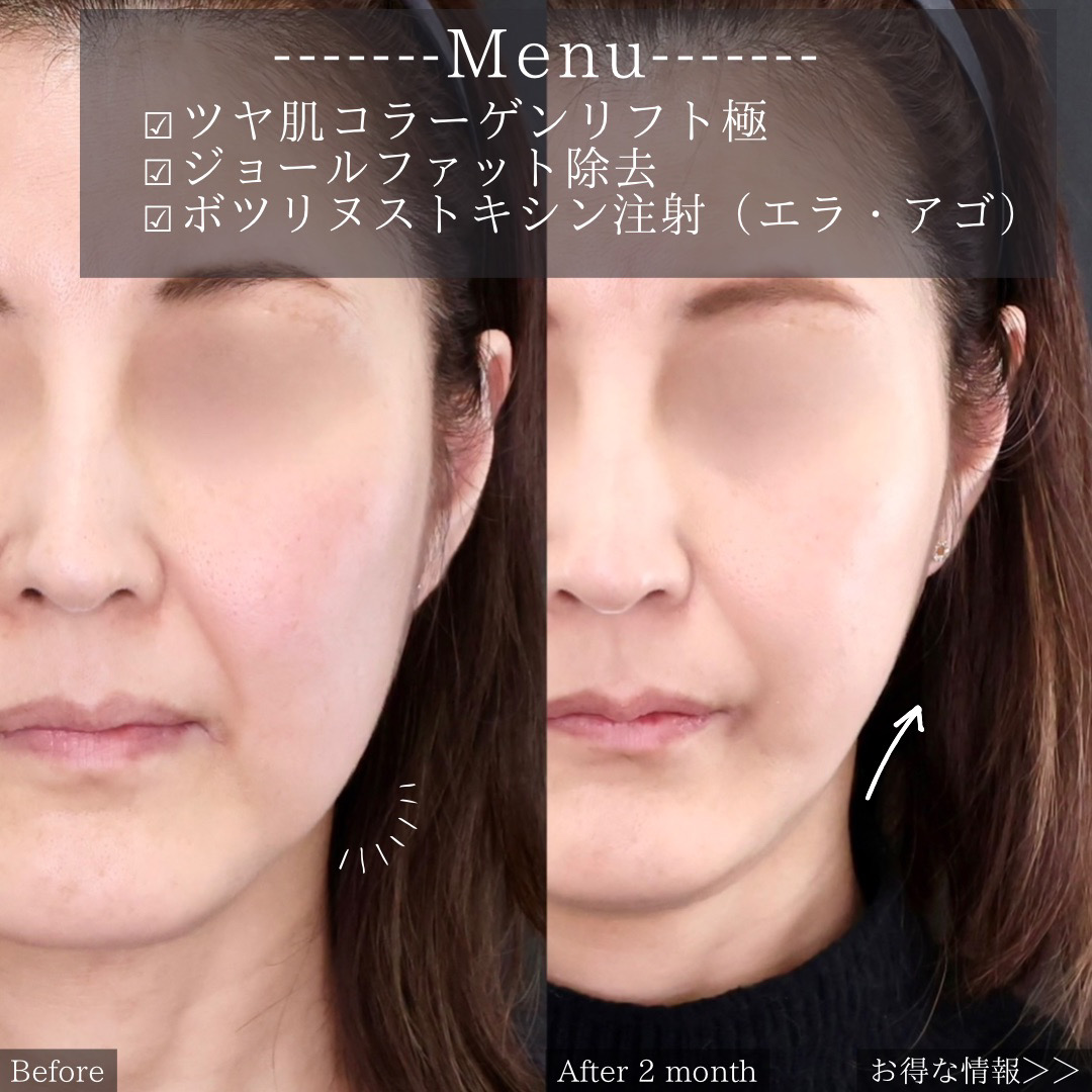 TAC式 ツヤ肌コラーゲンリフト®/ボトックス注射：その他/エラボトックス注射の症例写真 施術前後 