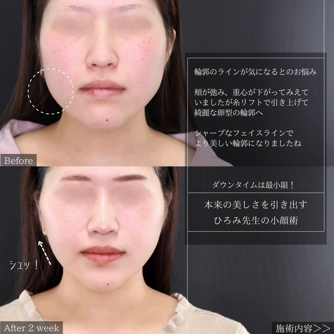 TAC式 ツヤ肌コラーゲンリフト®/エラボトックス注射/ボトックス注射:その他の症例写真 施術前後