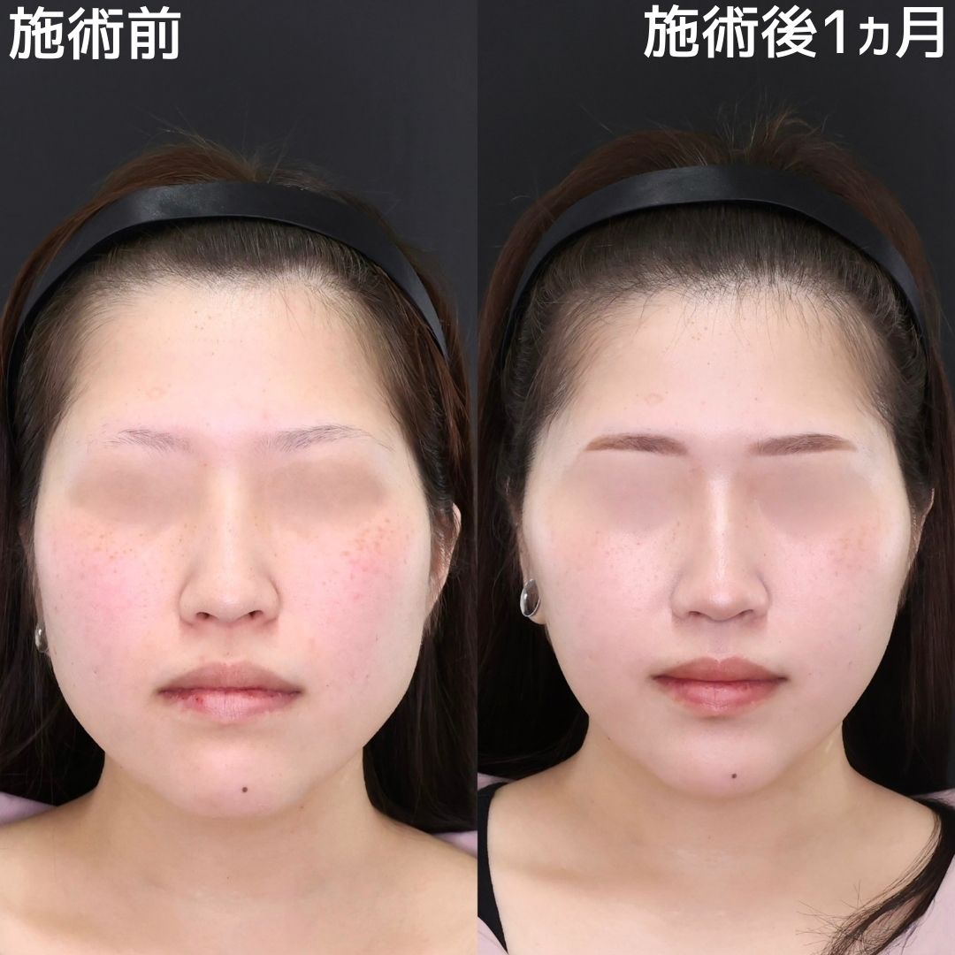 TAC式 ツヤ肌コラーゲンリフト®/エラボトックス注射/ボトックス注射:その他の症例写真 施術前後