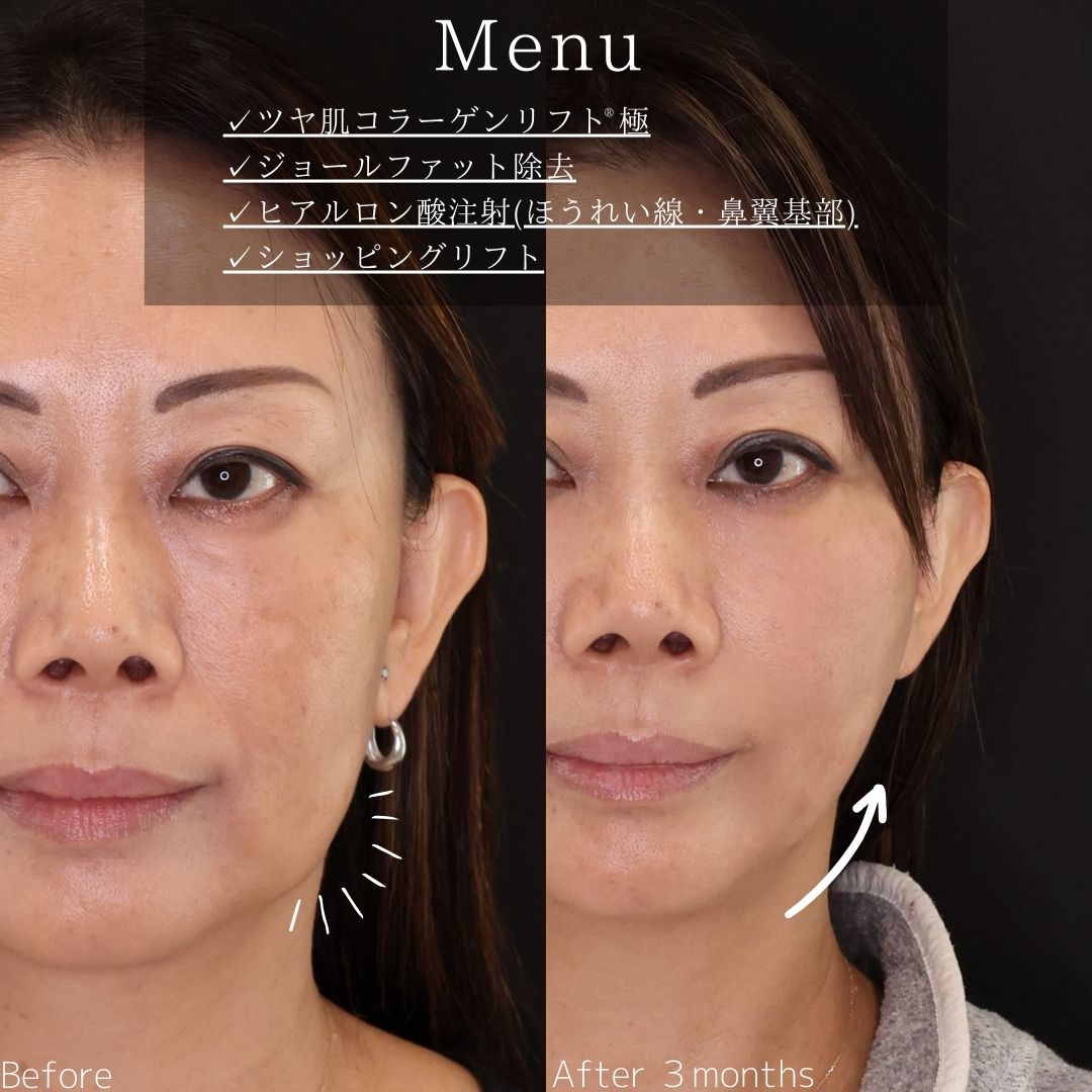 TAC式 ツヤ肌コラーゲンリフト®/ジョールファット除去/ほうれい線のヒアルロン酸注射の症例写真 施術前後 