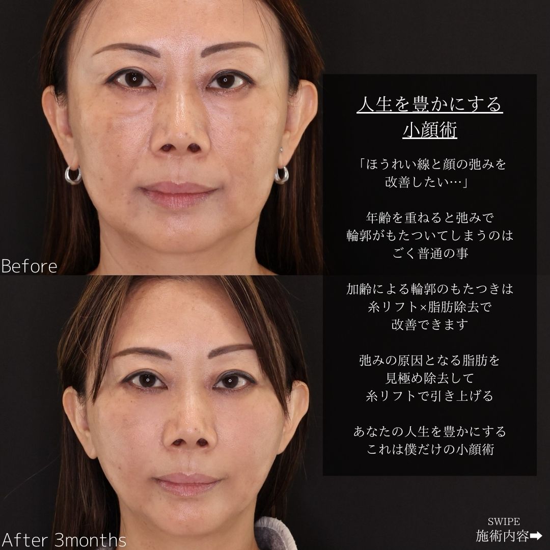 TAC式 ツヤ肌コラーゲンリフト®/ジョールファット除去/ほうれい線のヒアルロン酸注射の症例写真 施術前後 