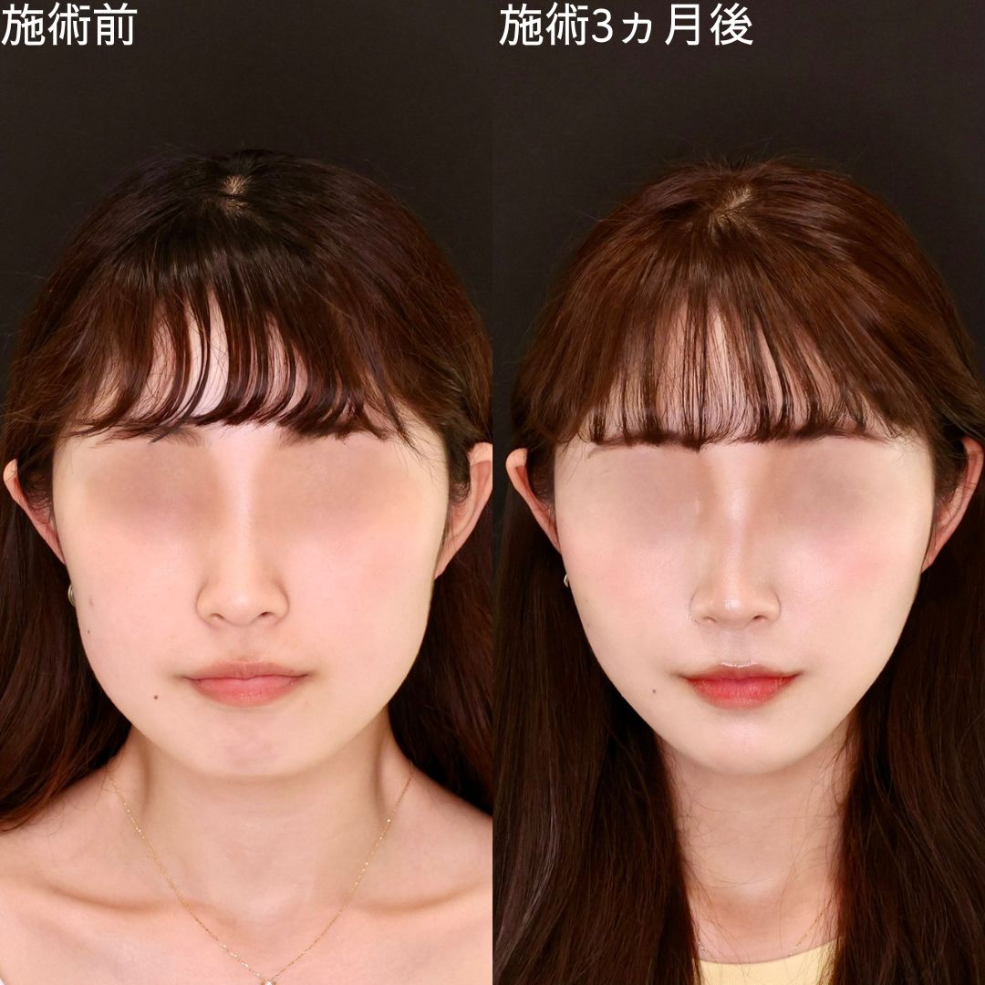 【糸リフト】本来の輪郭を引き出すモデル級小顔術