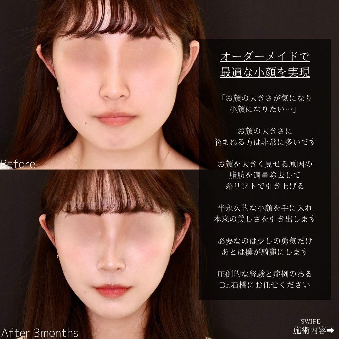 TAC式 ツヤ肌コラーゲンリフト®/体の脂肪吸引/ジョールファット除去の症例写真 施術前後 