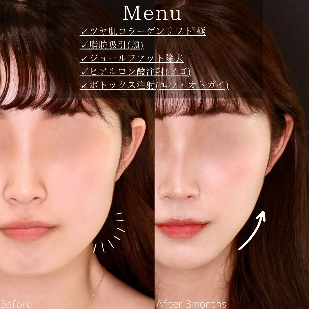 TAC式 ツヤ肌コラーゲンリフト®/体の脂肪吸引/ジョールファット除去の症例写真 施術前後 